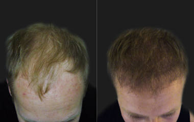 Hair Transplantation2 (1)